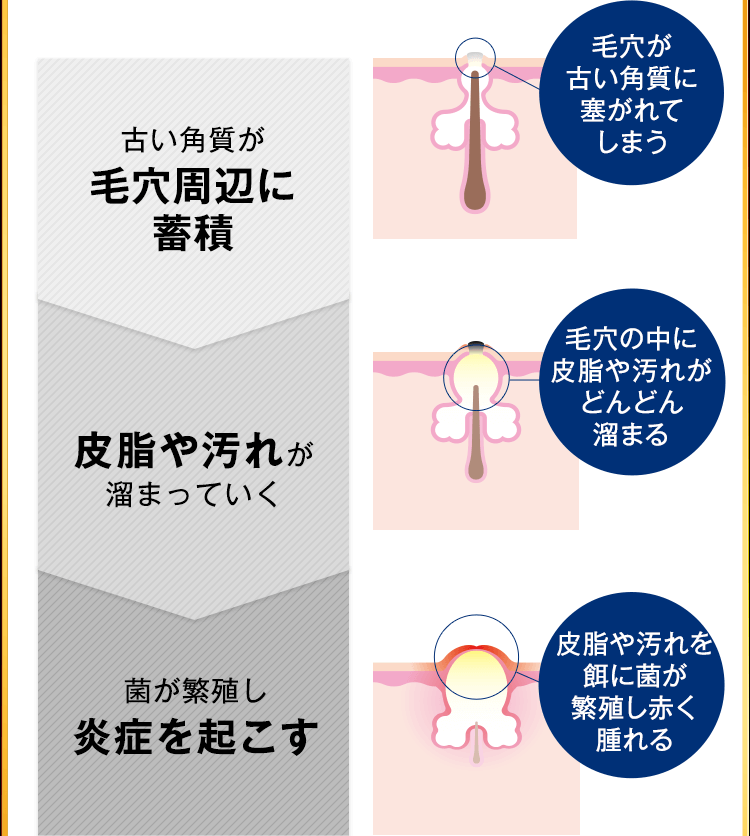 皮脂や汚れが溜まっていく